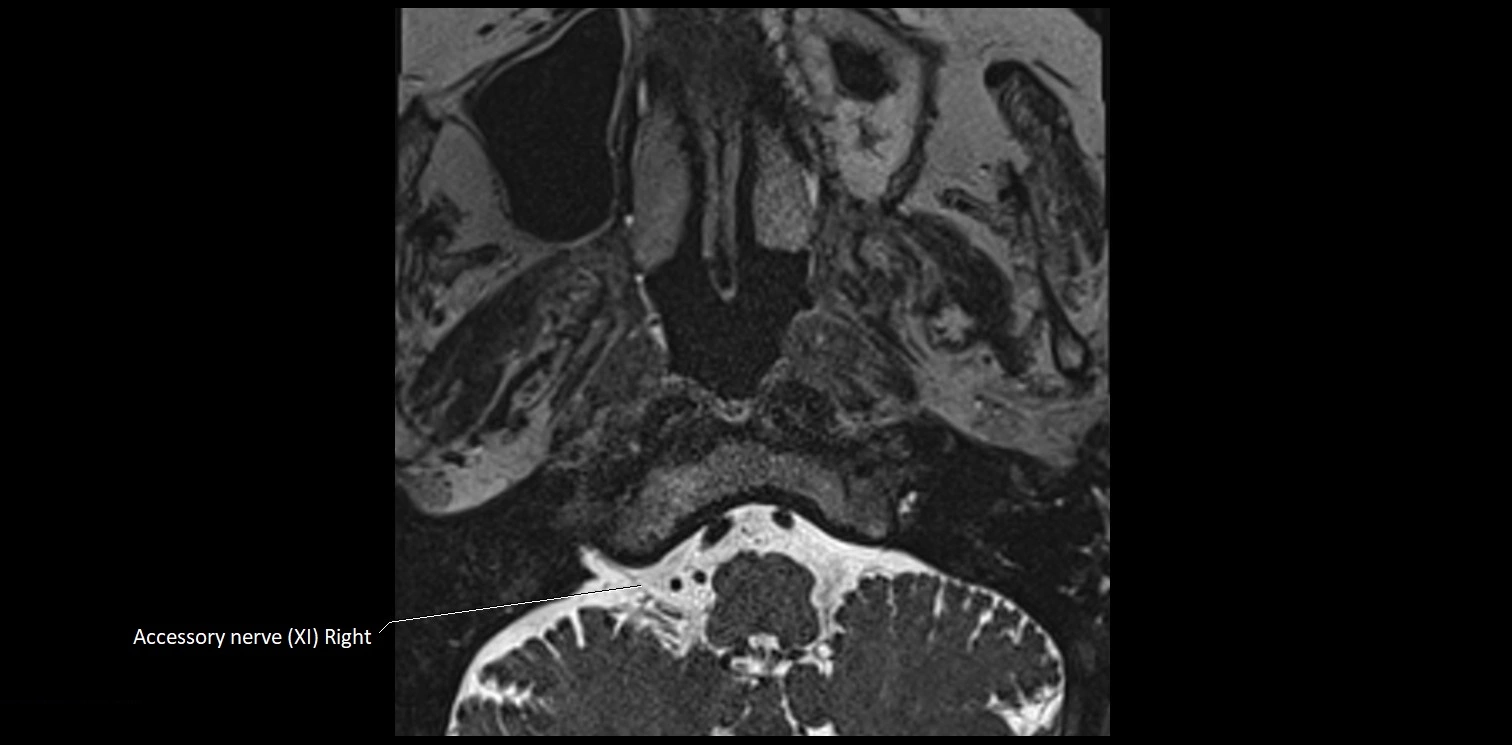 Cranial nerve anatomy axial MRI 3T image 74.webp